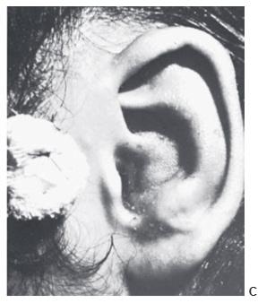 acute othematoma C