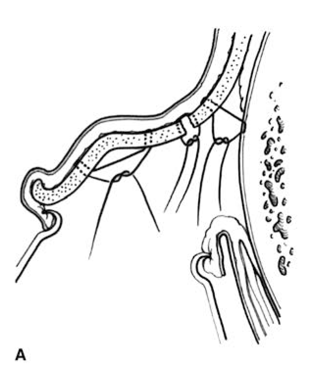 Conchal Alteration A