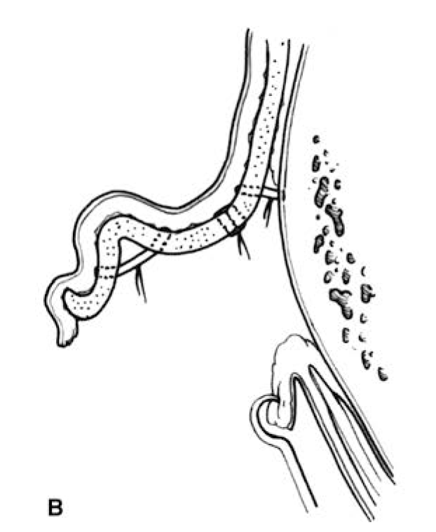 Conchal Alteration B