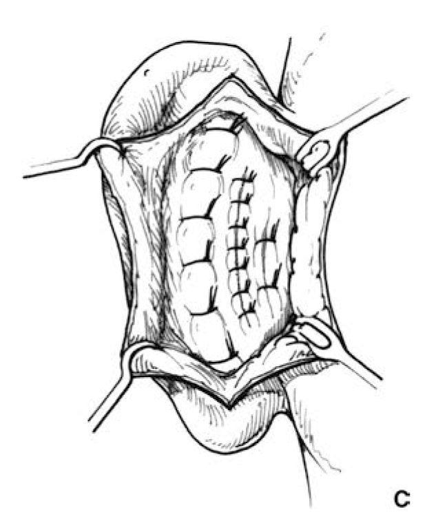 Conchal Alteration C