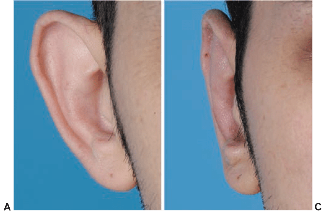 Choice of Otoplasty Technique A & C