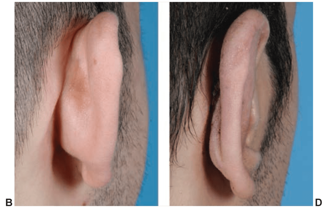 Choice of Otoplasty Technique B & D