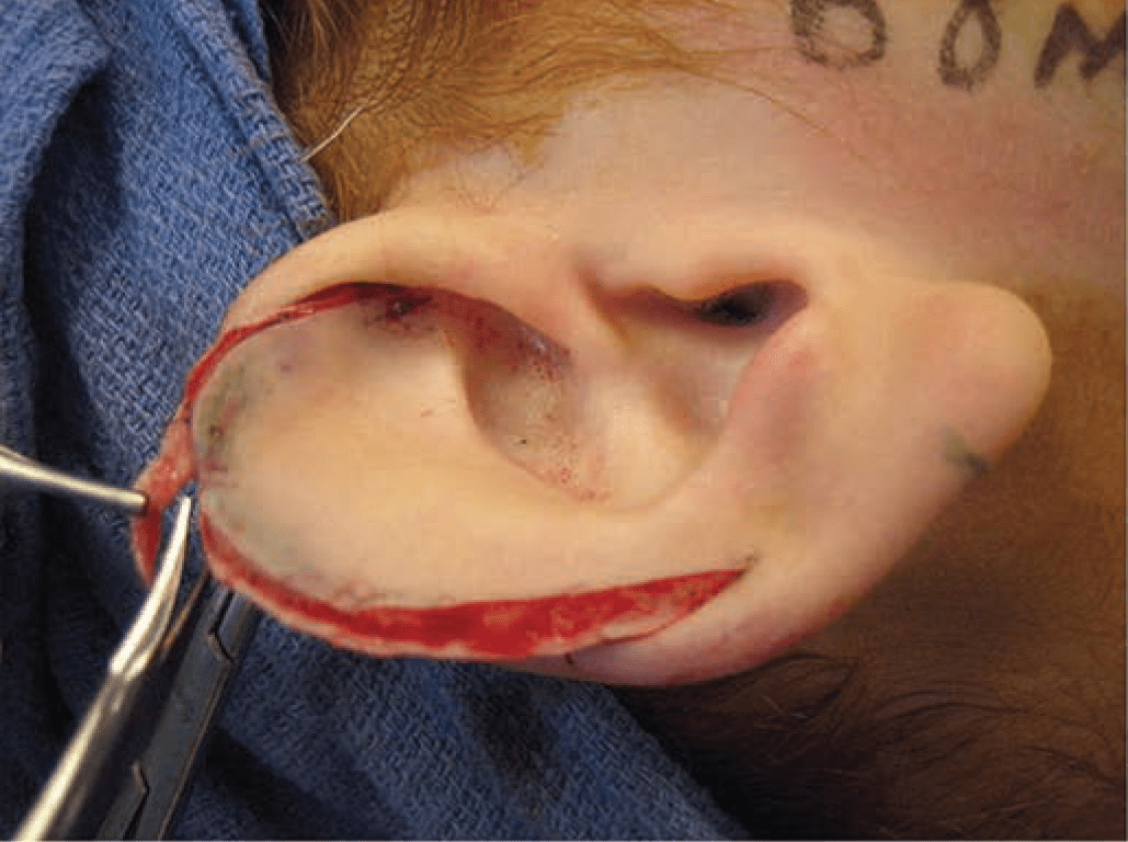Technique for reduction otoplasty 1
