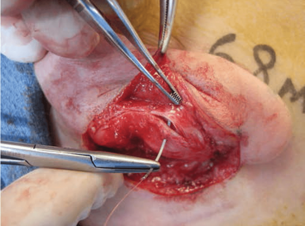 Technique for reduction otoplasty 2