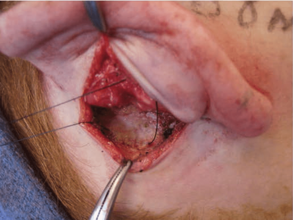 Technique for reduction otoplasty 3