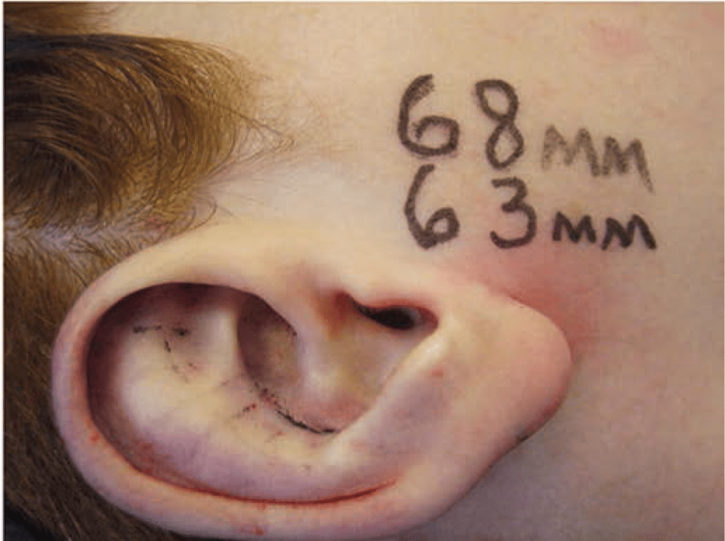 Technique for reduction otoplasty 4