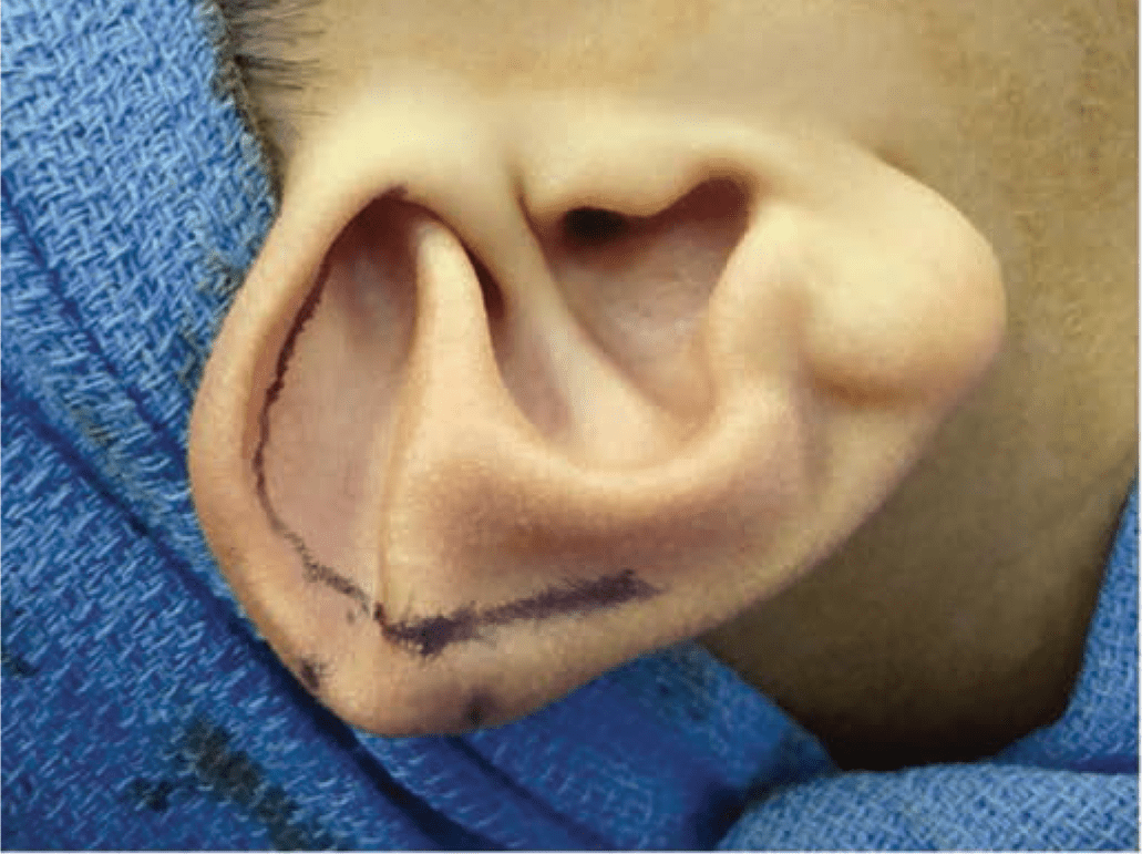 Technique for repair of Stahl’s ear 1