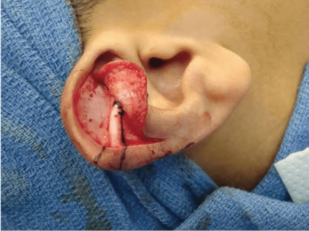 Technique for repair of Stahl’s ear 2
