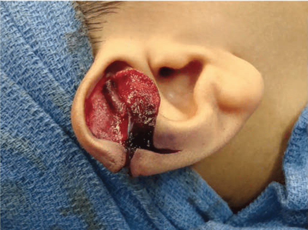 Technique for repair of Stahl’s ear 3