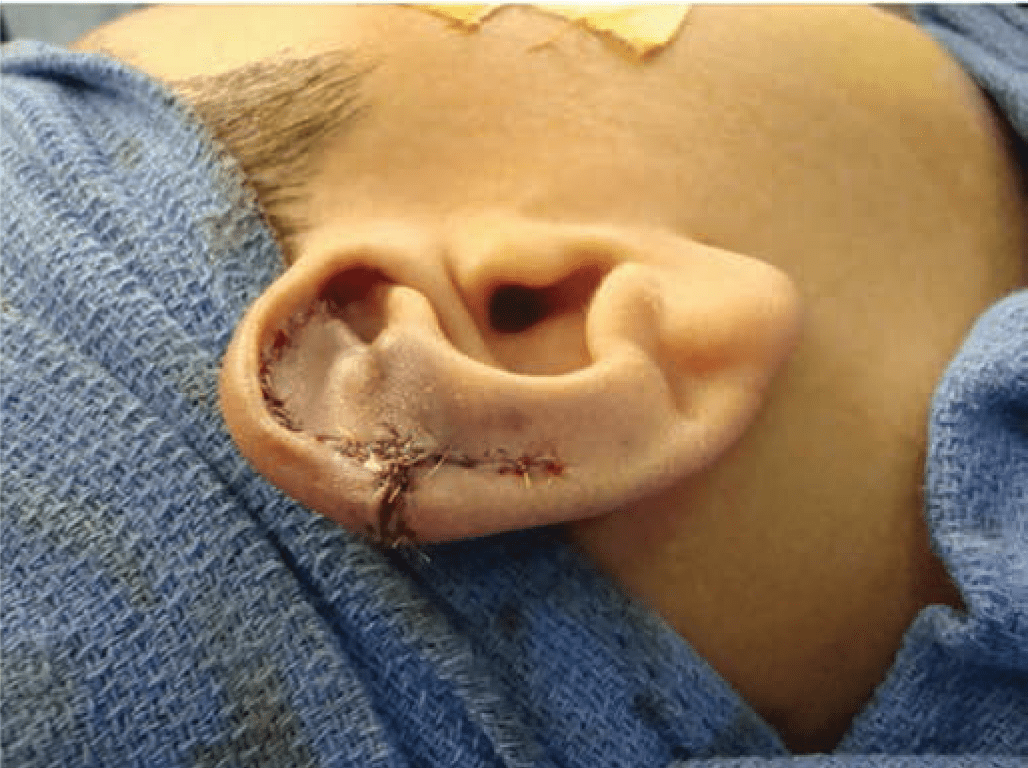 Technique for repair of Stahl’s ear 4