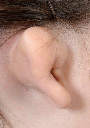 Patient's ear before aural atresia repair