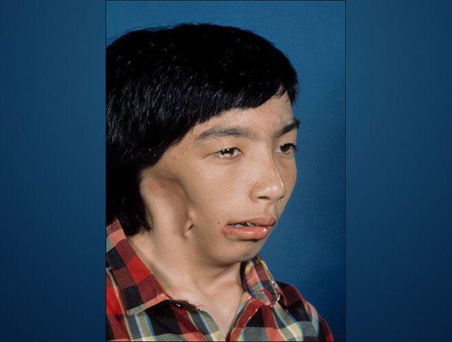 severe hemifacial microsomia